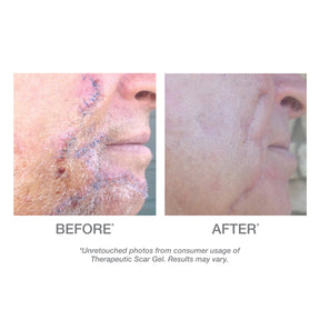 Scar Gel - ProCare Outlet by DERMA E